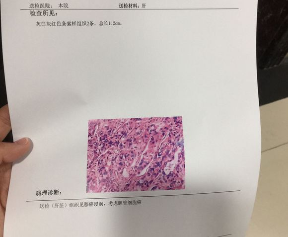 刚刚去拿了我爸的活检报告。一二肝门部都有
