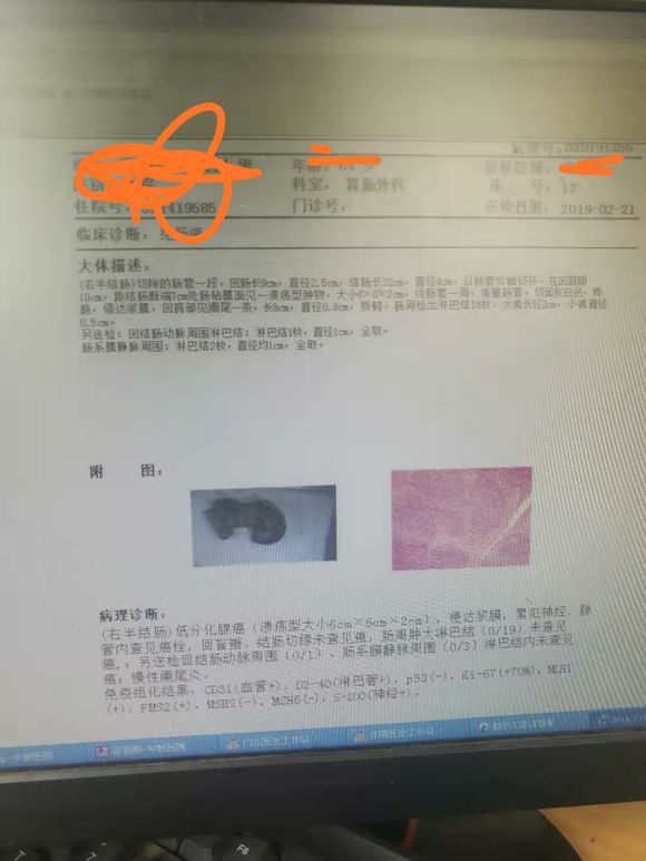 父亲结肠Ca肝曲位置肿瘤，提到侵犯神经，医生建议化疗