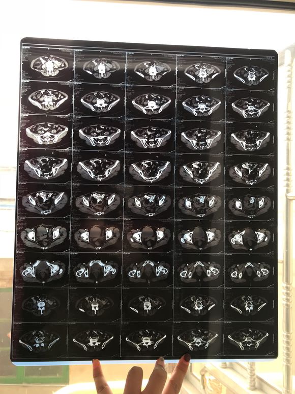 有子宫肉瘤的吗？