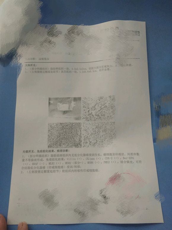 7月底弟弟查出结肠癌